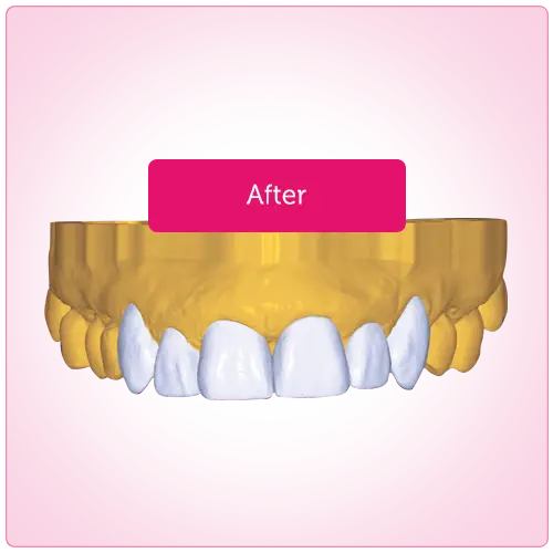 Smile Design After