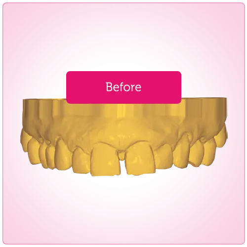 Smile Design Before