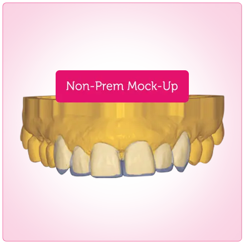 Smile Design Non-Prep Mock-Up