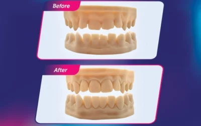 What’s Included in Our Smile Design Package?