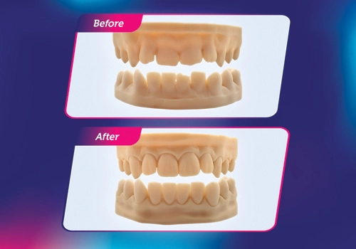 What’s Included in Our Smile Design Package?